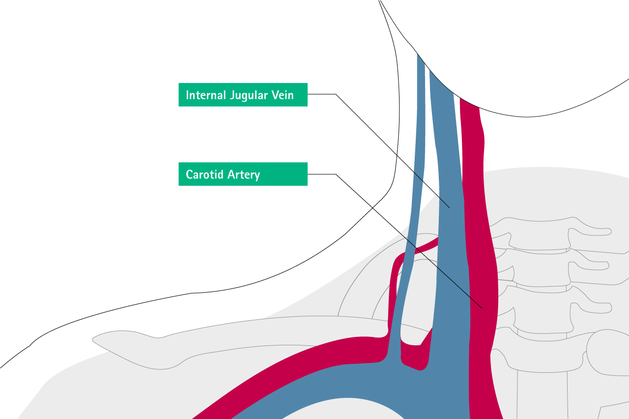 Misplacement and Malposition of Central Venous Catheters