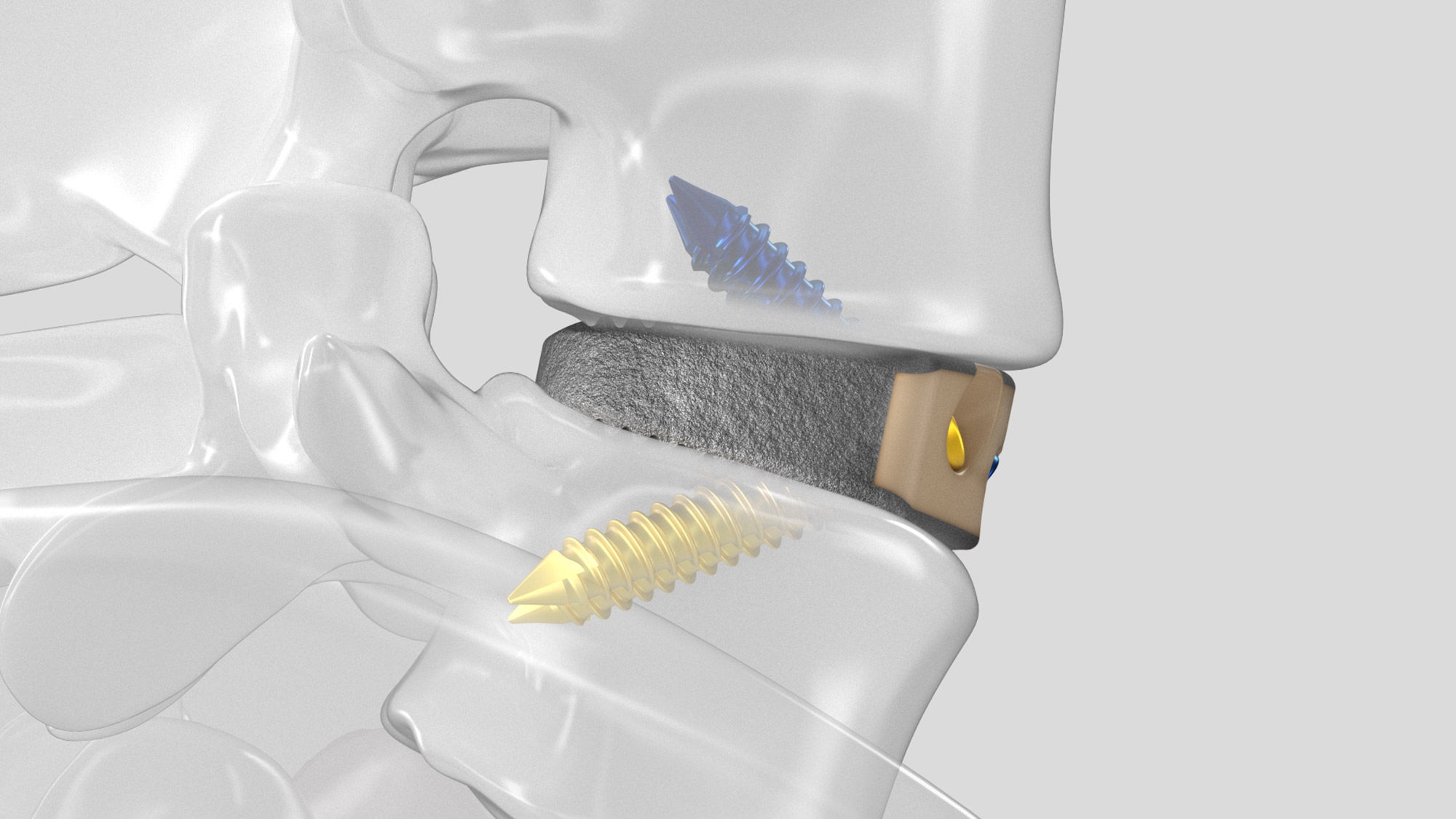 Side view of the inserted Aesculap Arcadius XP C implant in a spine model