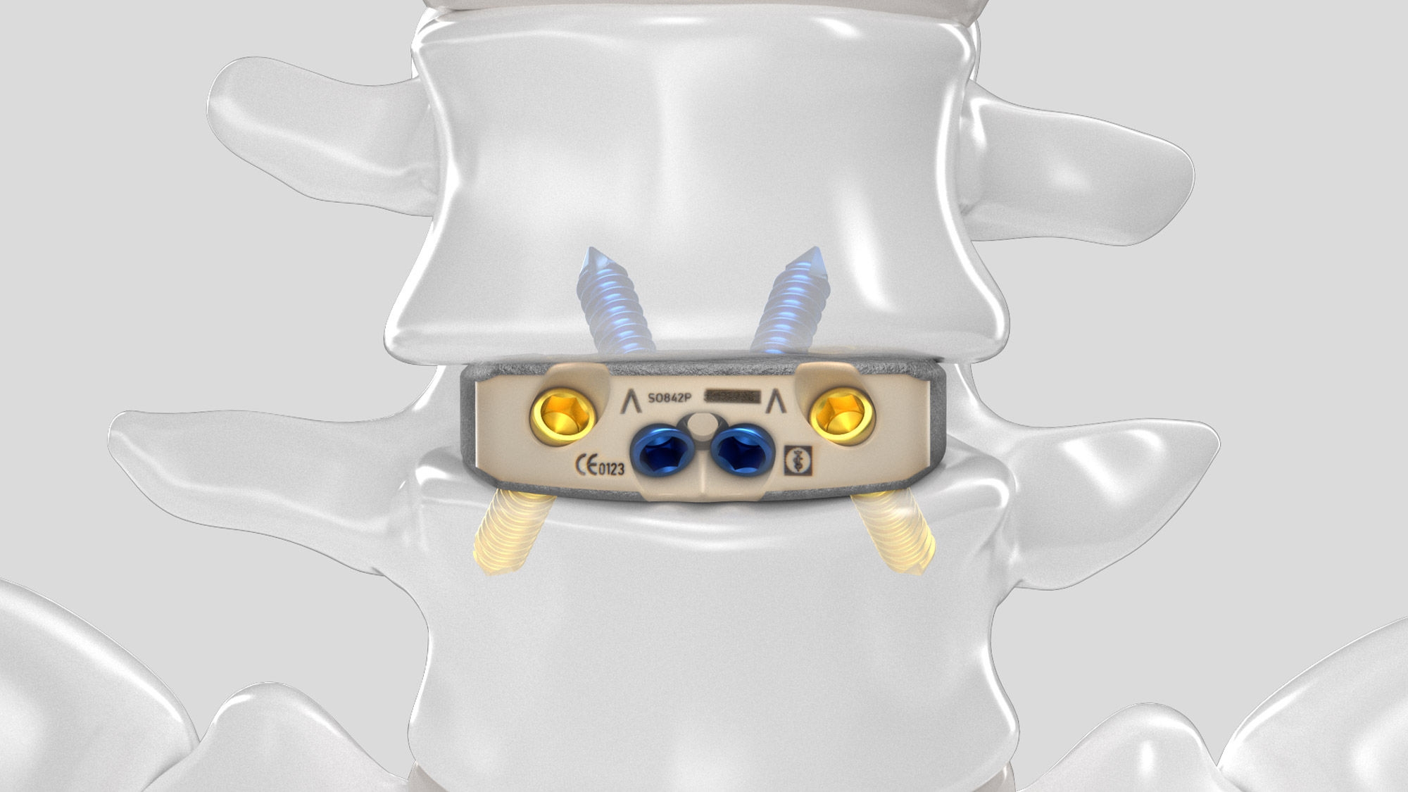 Frontal view of the inserted Aesculap Arcadius XP L implant in a spine model