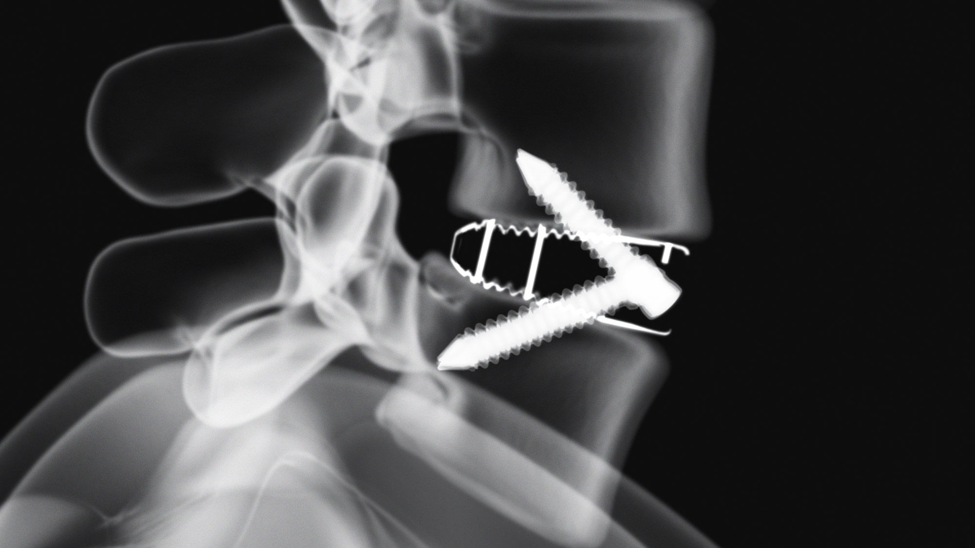 X-rax view of the inserted Aesculap Arcadius XP L implant in a spine model