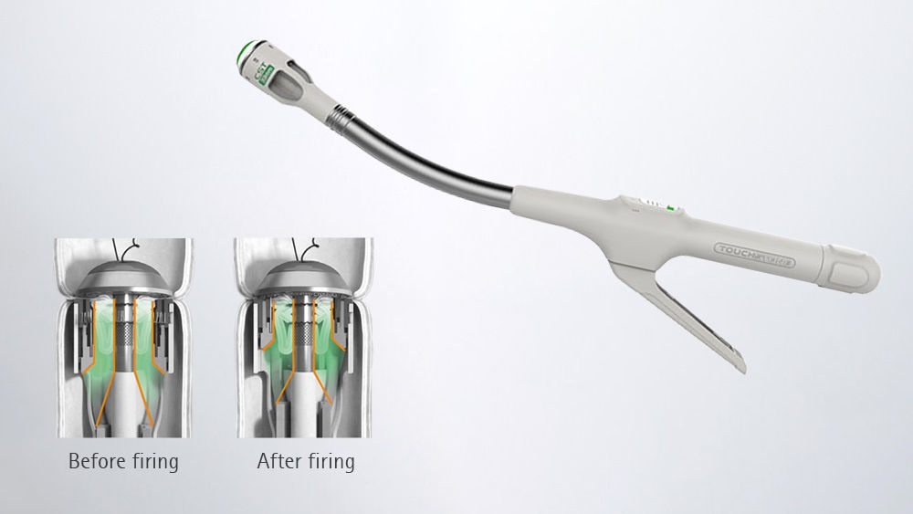 CSC-KOL® internal staplers in low colorectal anastomosis