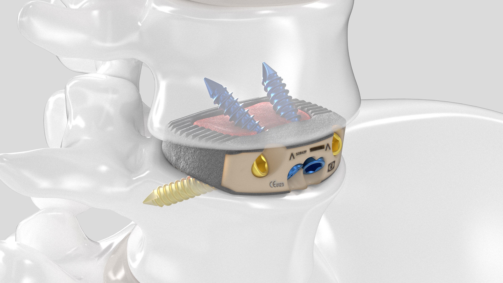 Slight top view of the inserted Aesculap Arcadius XP L implant in a spine model