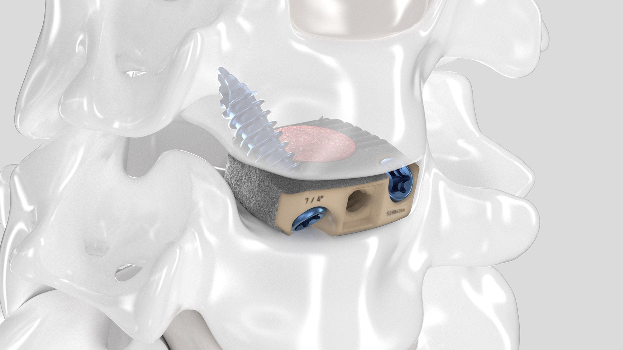 Slight top view of the inserted Aesculap Arcadius XP C implant in a spine model