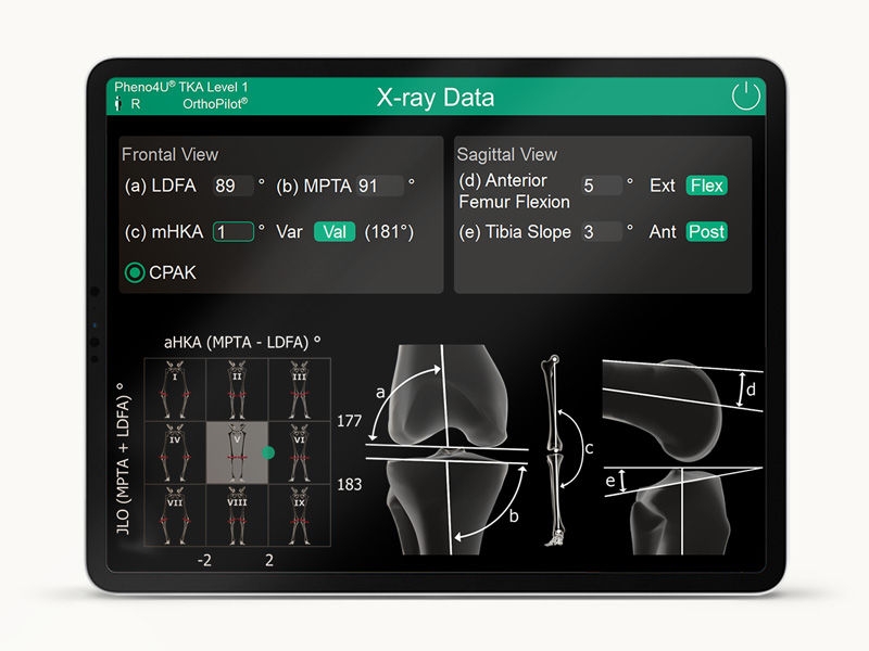 OrthoPilot Elite screen with x-ray data and CPAK classification.