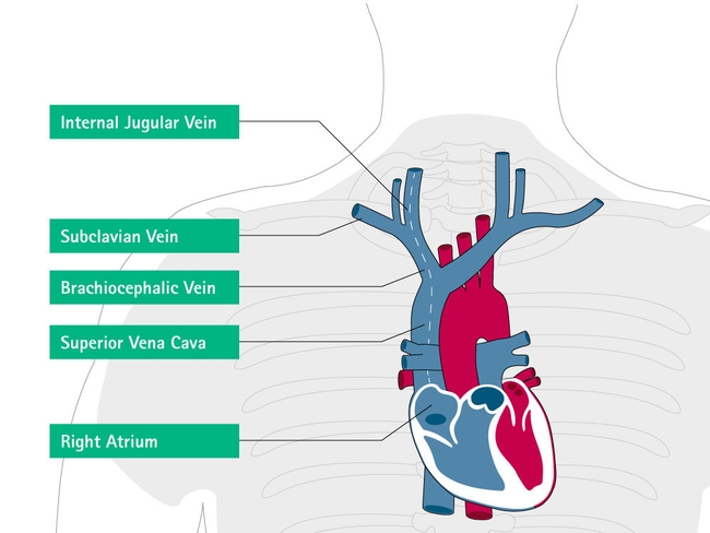 Misplacement and Malposition of Central Venous Catheters - B. Braun