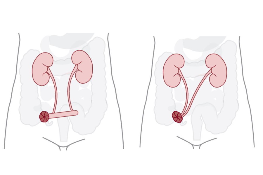 living-with-a-stoma